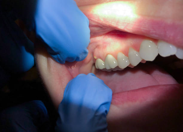 Best Emergency Care for Gum Disease in Milford, IA
